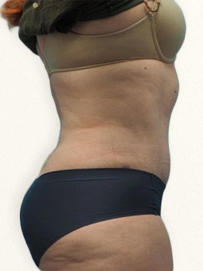After body treatment for weight loss at CaraBella Skin