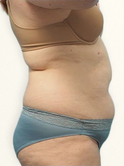 Before body treatment for weight loss at CaraBella Skin