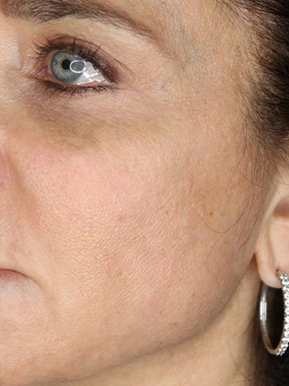 After anti-aging facial treatment at CaraBella Skin