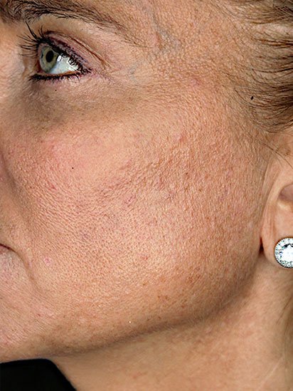 Before anti-aging facial treatment at CaraBella Skin