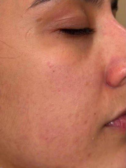 After eyebrow micropigmentation at CaraBella Skin