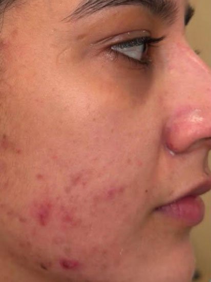 Before eyebrow micropigmentation at CaraBella Skin