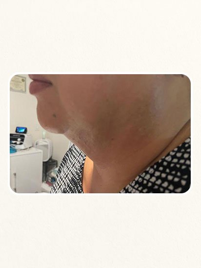 Before skincare treatment at CaraBella Skin