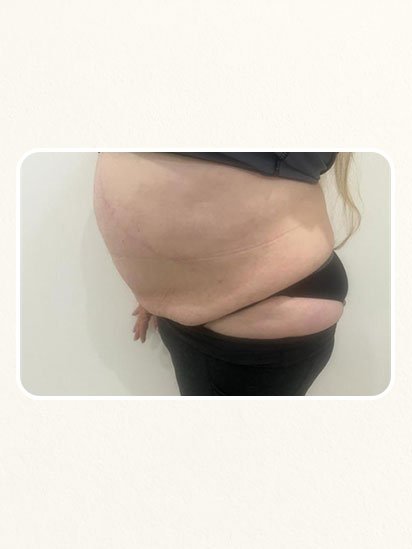 Before skincare treatment at CaraBella Skin