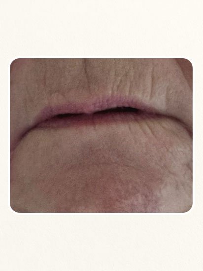 Before skincare treatment at CaraBella Skin