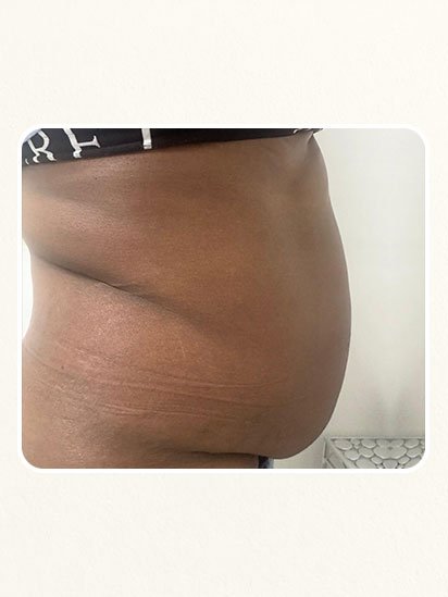 Before skincare treatment at CaraBella Skin